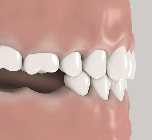 Konsequenzen Verlust Backenzähne