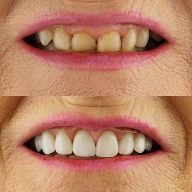  Patientenfall 1 von Dr. Appel - Ästhetische Zahnheilkunde München
