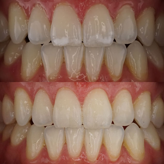  Patientenfall 2 von Dr. Appel - Ästhetische Zahnheilkunde München