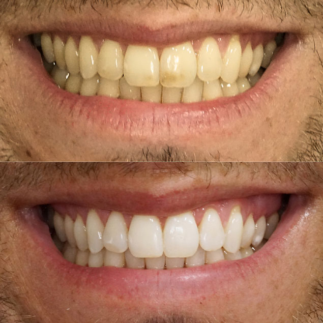  Patientenfall 3 von Dr. Appel - Ästhetische Zahnheilkunde München