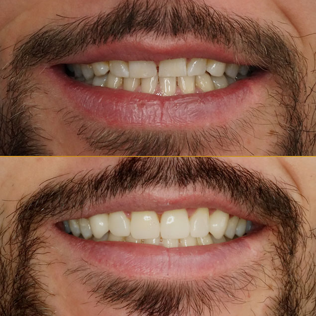 Patientenfall 4 von Dr. Appel - Ästhetische Zahnheilkunde München