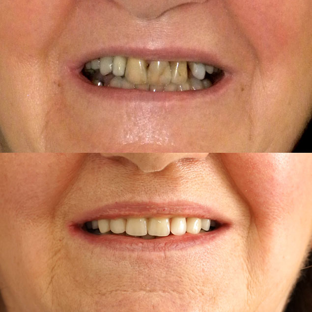 Patientenfall 5 von Dr. Appel - Ästhetische Zahnheilkunde München